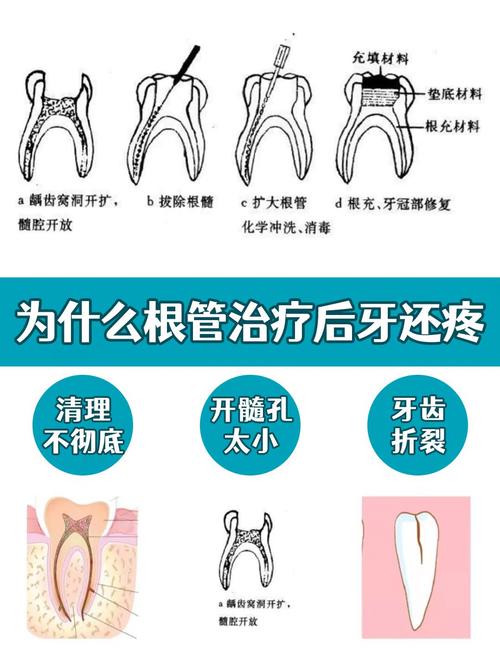 南京根管治疗是种牙吗 别再混淆两者天差地别