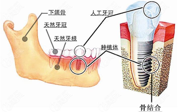 南京深圳瑞士ITI种植牙 牙槽骨条件要求详解