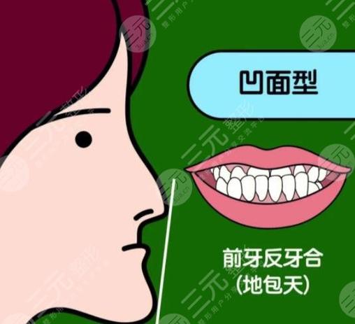 南京深圳儿童地包天矫正多少钱？2026最新价格表来了