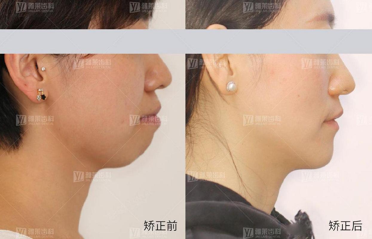 南京矫正牙齿对脸型的改变到底有多大？真实对比告诉你