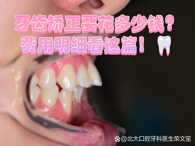 南京广州牙齿矫正到底要花多少钱？看完这篇不踩坑