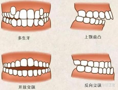 牙齿矫正广州哪个医院好_广州矫正牙齿一般要花多少钱_广州牙齿矫正多少钱