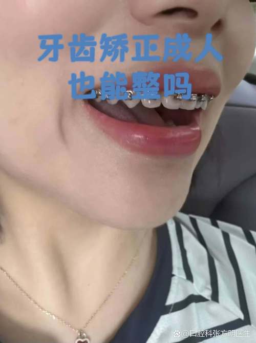 南京成人地包天牙齿矫正 成年人还能做吗效果好吗