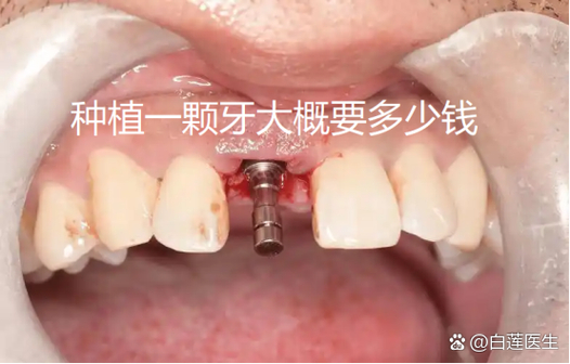 南京纯钛种牙多少钱一颗？费用明细和影响因素都在这里