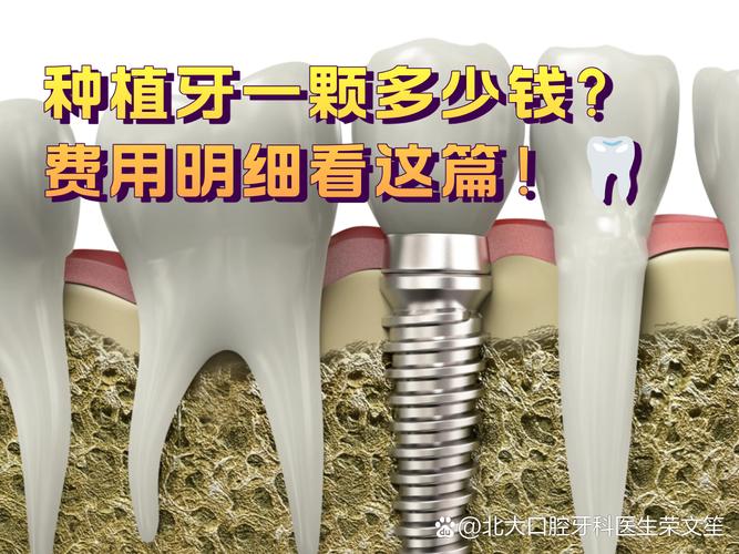 南京2025年种牙一颗到底要花多少钱？看完这篇不踩坑
