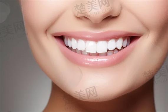 南京杭州自锁牙齿矫正多少钱？真实费用全揭秘