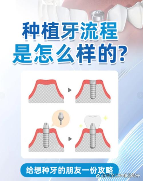 南京上门牙种牙要多久 门牙种植美观又牢固