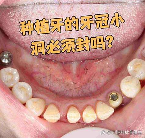 南京深圳龙华全口种植牙当天戴牙冠,靠谱吗?