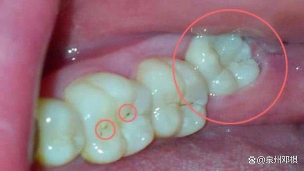 南京拔牙后能马上种牙吗？看完这篇就懂了
