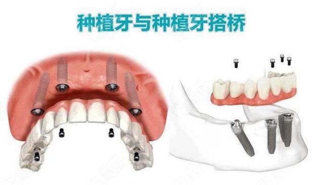南京种植牙还是搭桥哪个更好