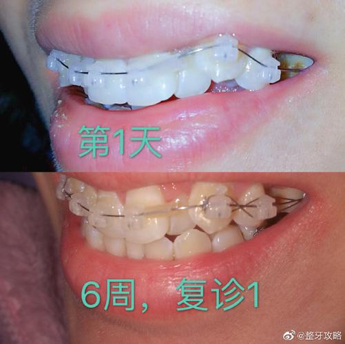 南京深圳牙缝过大矫正多少钱 价格表一览