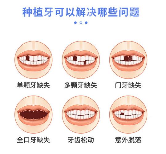 南京宝安新安种植牙哪家医院好？靠谱选择看这几点