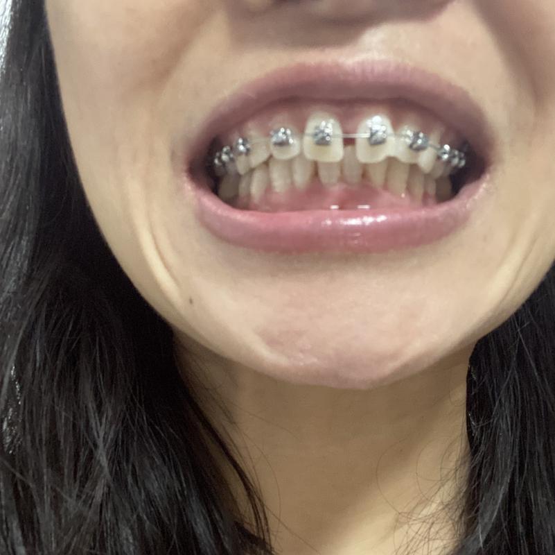 南京40岁还能矫正牙齿吗?真实案例告诉你答案