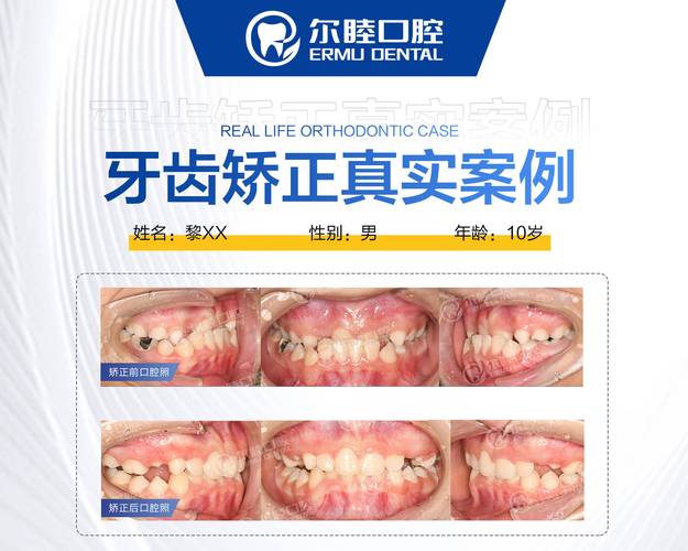 南京深圳龙华钢丝矫正哪里好？选对牙科很关键