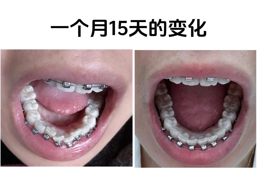 牙齿矫正可以改变脸型吗_牙齿矫正可以只做上排牙吗_38岁可以牙齿矫正吗