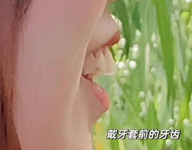 南京深圳骨性龅牙正畸选哪家医院?骨科正畸避坑全攻略