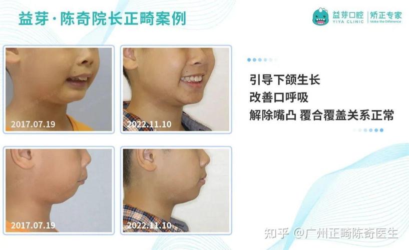 南京东莞儿童牙齿矫正几岁开始最好?家长别等换完牙才后悔