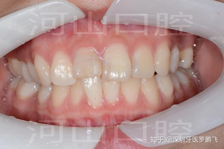 南京20岁牙齿还能不能矫正?成年人正畸真实情况揭秘