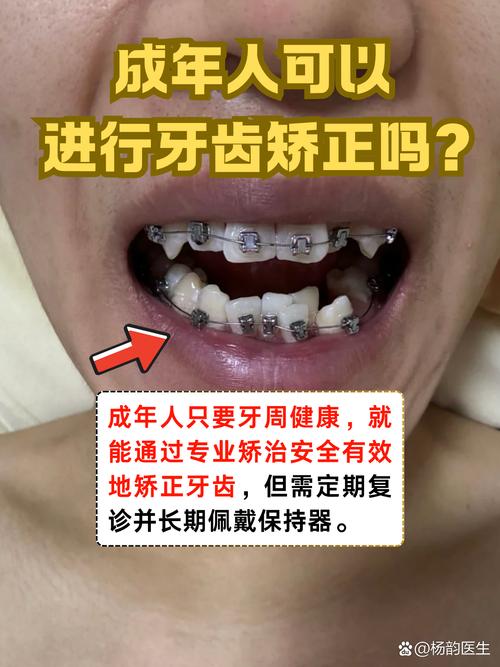 南京30岁矫正牙齿还来得及吗 成年人正畸必看
