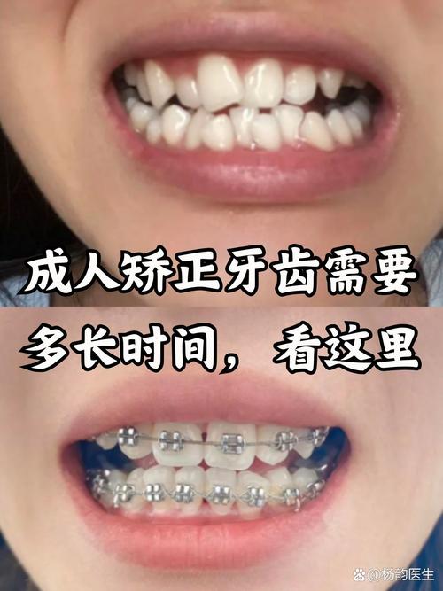 南京35岁做牙齿矫正还来得及吗 真实效果和花费揭秘