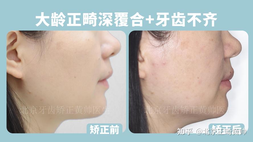 南京45岁做深覆合矫正大概多少钱？费用明细全公开