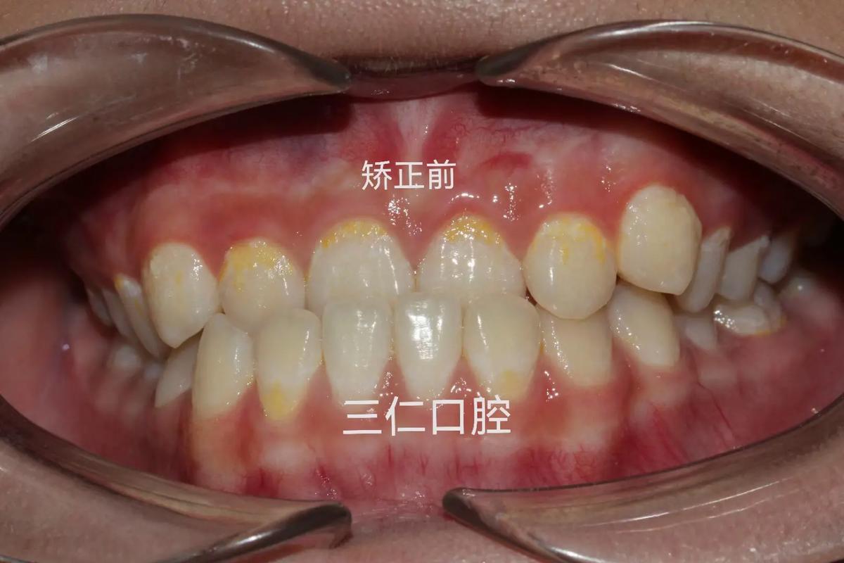 南京地包天牙齿矫正别再拖