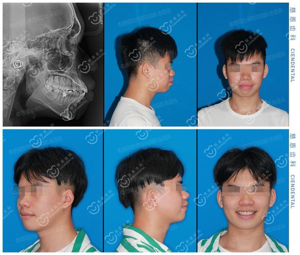南京深圳罗湖骨性龅牙隐形矫正能行吗？方案详解