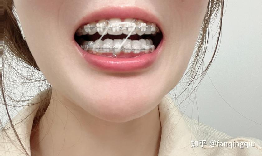 南京27岁做牙齿矫正还来得及吗