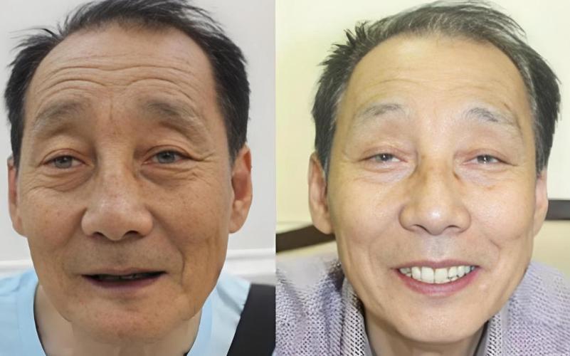 南京半口种植牙好不好用?过来人真实经历告诉你