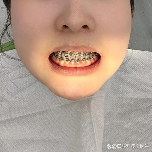 南京50岁门牙突出还能整吗?牙医说了实话