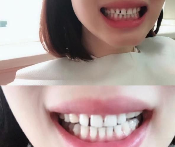 南京成都钢丝矫正牙齿要多少钱？真实价格全曝光