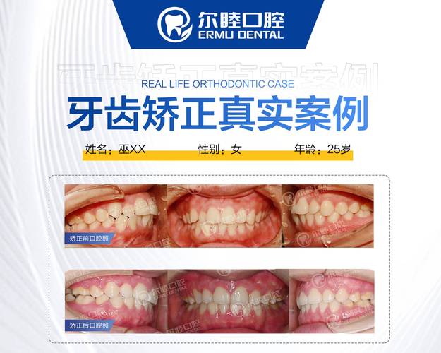 南京深圳宝安金属自锁托槽矫正哪里好?公立和私立医院怎么选