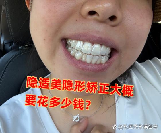 南京深圳龙岗隐适美牙套多少钱?收费明细看这篇