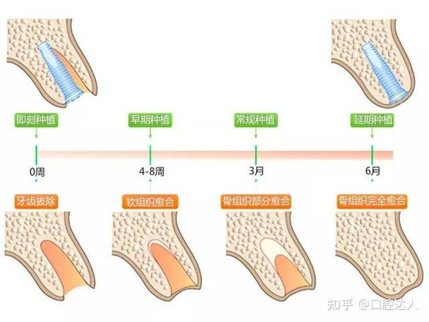 南京掉3颗牙怎样种植？种牙流程全解析+费用避坑指南