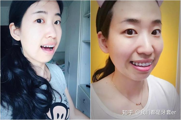 南京30岁做牙齿矫正晚不晚？真实情况告诉你