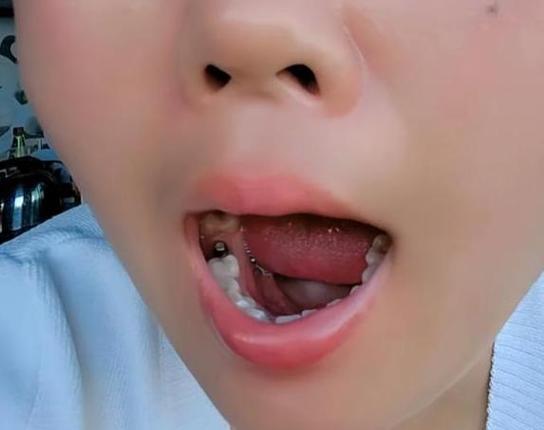南京55岁种牙好还是镶牙好？一文告诉你答案