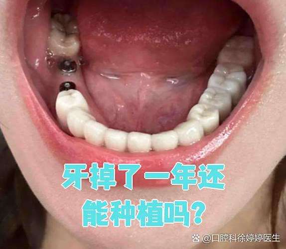 南京牙齿掉了还能种吗？现在种牙靠谱不靠谱