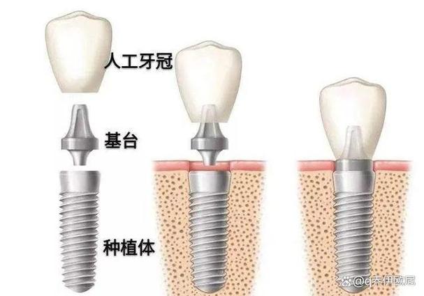 南京集采种牙和自费种牙到底差在哪