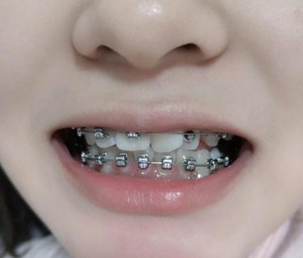 南京30岁做牙齿矫正有什么后遗症?看完这篇不踩坑