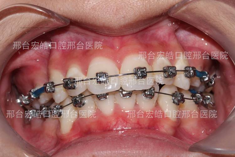 南京不整齐牙齿矫正到底要花多少钱？大概多久能好？