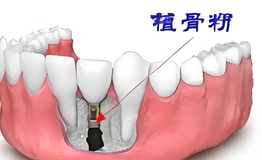 南京38岁做种植牙到底贵不贵？术后能管多少年？