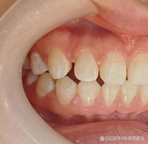 南京深圳牙缝过大矫正报价大概多少钱?