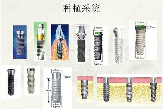 南京种植牙国产韩系欧美价格对比,哪个品牌性价比高?