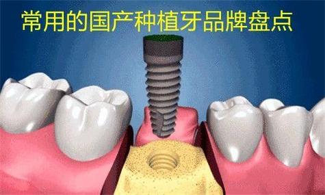南京潍坊国产种植牙百康特多少钱一颗?
