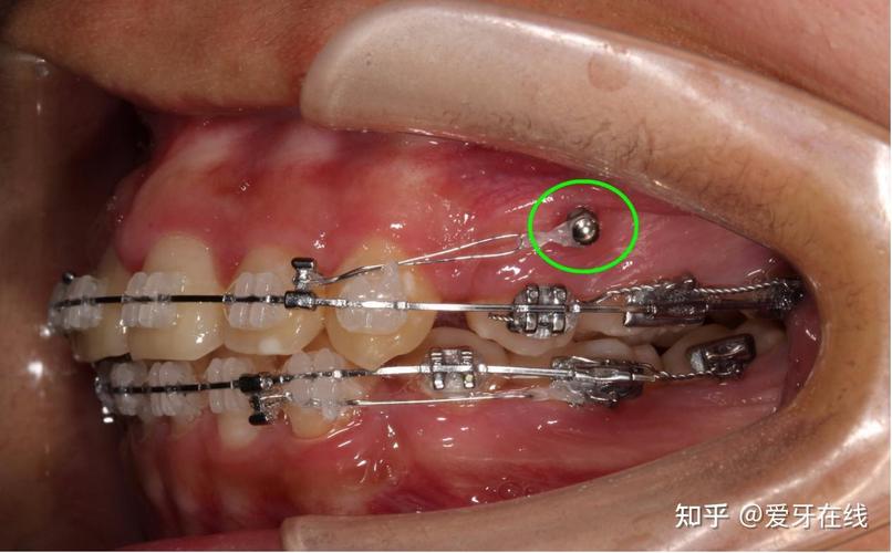 南京20多岁矫正牙齿会后悔吗？医生说大实话