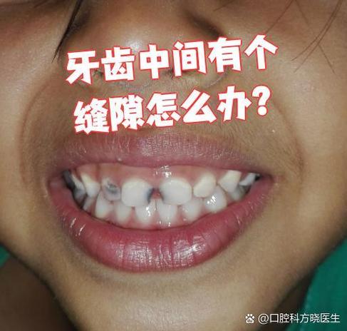 南京门牙有缝怎么矫正？这几种方法亲测有效