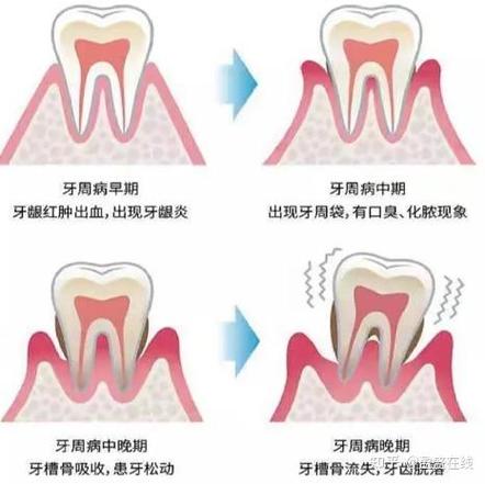 南京三十岁还能整牙吗？成人牙齿矫正必知真相