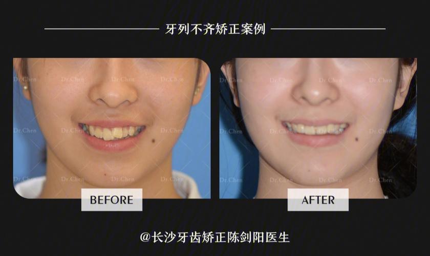 南京拔门牙矫正牙齿会松动吗？正畸医生说出大实话