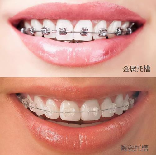 南京深圳深覆合矫正价格大揭秘