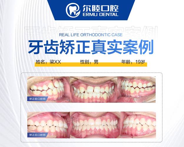矫正报价深圳牙缝过大的医院_深圳牙缝过大矫正报价_牙齿矫正牙缝大价目表